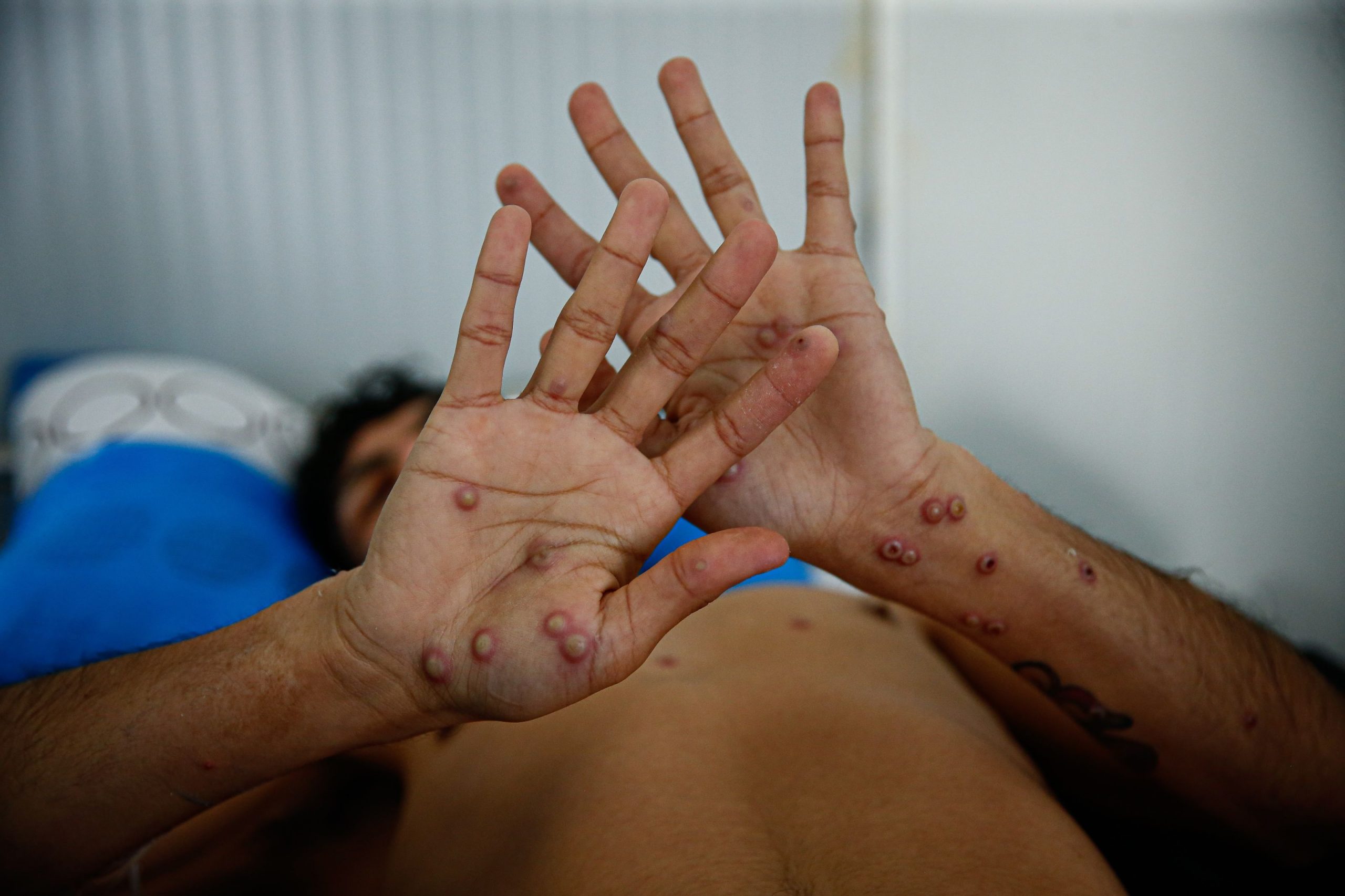 OMS: Variola maimuţei rămâne o urgenţă de sănătate publică