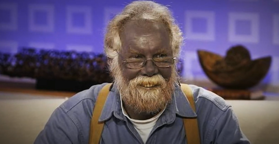 Un bărbat a devenit celebru după ce pielea sa a căpătat o nuanță șocantă de albastru