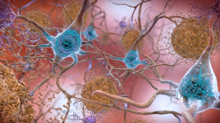 Experții chinezi anunţă primul caz de Alzheimer la un pacient de 19 ani