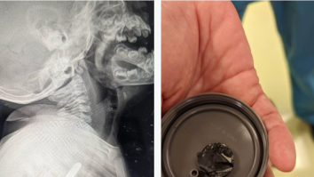 Un băiețel înghite o baterie și supraviețuiește după ce i-a rămas blocată în gât timp de 5 săptămâni