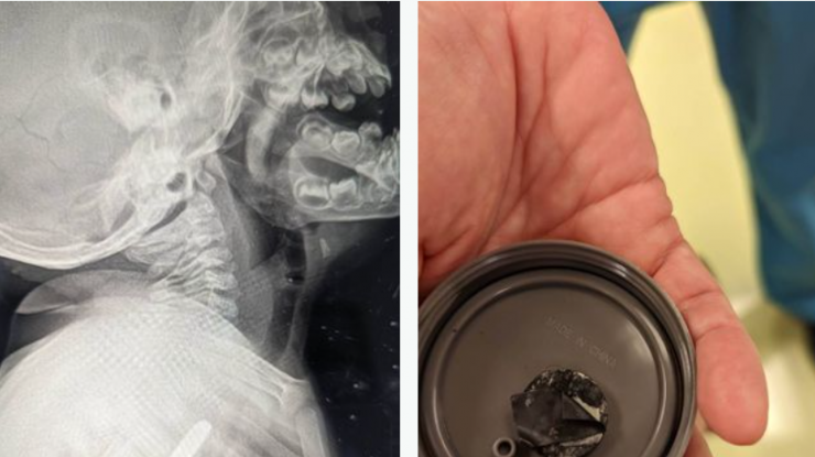 Un băiețel înghite o baterie și supraviețuiește după ce i-a rămas blocată în gât timp de 5 săptămâni
