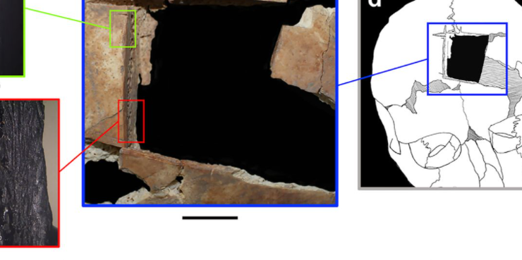 Oamenii de știință descoperă dovezi ale unui tip rar de operație pe creier, de acum 3.500 de ani, efectuată pe doi frați