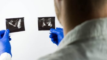 STUDIU. Majoritatea bărbaților diagnosticați cu cancer de prostată nu trebuie să se grăbească la operație, tratamente cu radiații