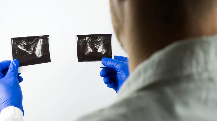 STUDIU. Majoritatea bărbaților diagnosticați cu cancer de prostată nu trebuie să se grăbească la operație, tratamente cu radiații