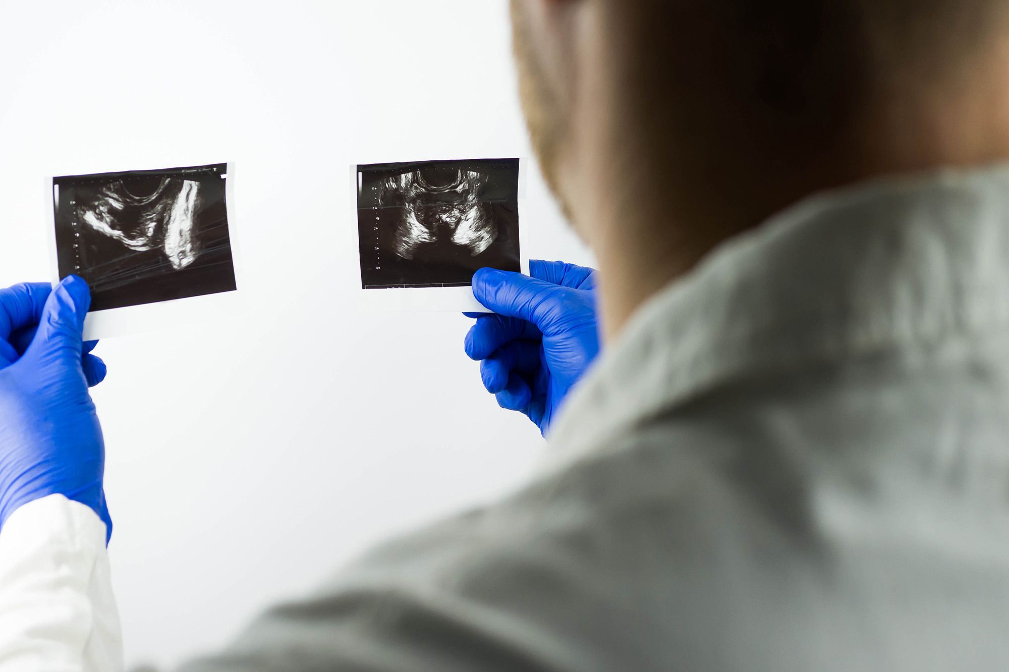 STUDIU. Majoritatea bărbaților diagnosticați cu cancer de prostată nu trebuie să se grăbească la operație, tratamente cu radiații