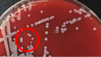 STUDIU: O singură enzimă ar putea cauza depresia. Cum afectează sănătatea femeilor