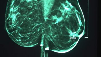 Inteligența artificială detectează semnele timpurii ale cancerului de sân. Cum funcționează tehnologia