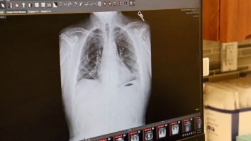 Un tratament pentru cancer pulmonar are rezultate impresionante și reduce la jumătate riscul de deces