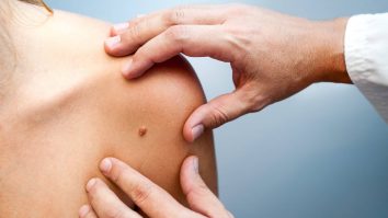 Lentilele de telefon care descoperă cancerul de piele. Cum funcționează dispozitivul pentru a diagnostica pacienții