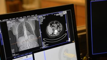 STUDIU. O pastilă administrată zilnic poate reduce la jumătate riscul de deces cauzat de cancerul pulmonar