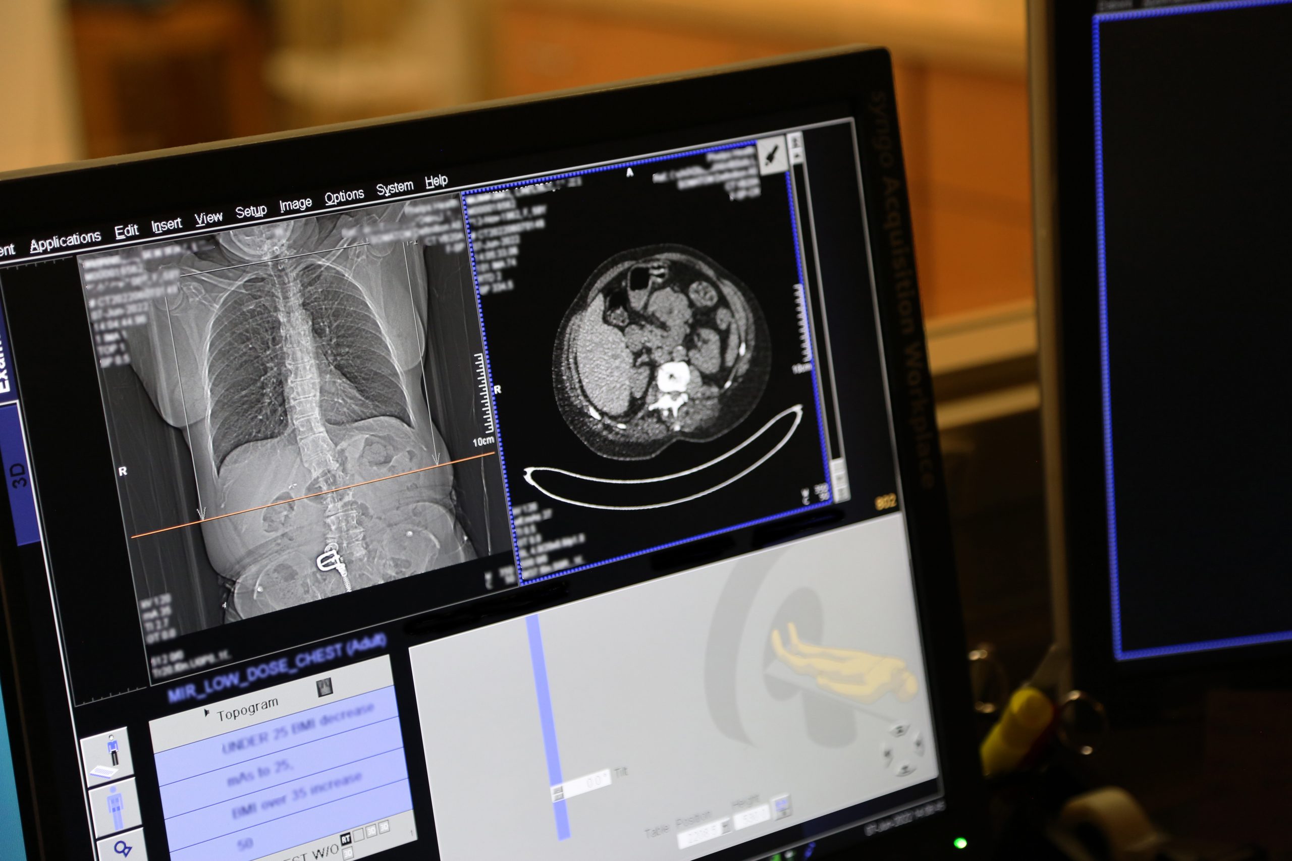 STUDIU. O pastilă administrată zilnic poate reduce la jumătate riscul de deces cauzat de cancerul pulmonar
