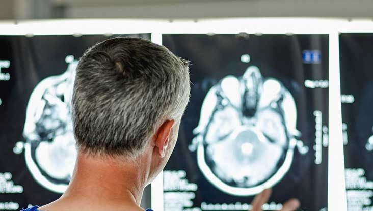 Rezultate finale pentru medicamentul pentru Alzheimer produs de Eli Lilly:  încetinește declinul cognitiv cu 35%. Care sunt primii europeni care îl vor folosi