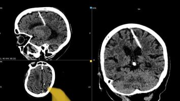O femeie a trăit toată viața cu un ac de 3 cm în creier. Ce ipoteze au medicii despre cazul bătrânei