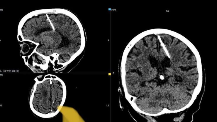 O femeie a trăit toată viața cu un ac de 3 cm în creier. Ce ipoteze au medicii despre cazul bătrânei
