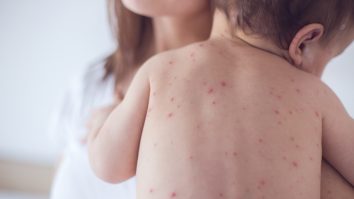 Epidemie de rujeolă: Cazurile cresc cu 3000% față de anul trecut. Ce trebuie făcut?