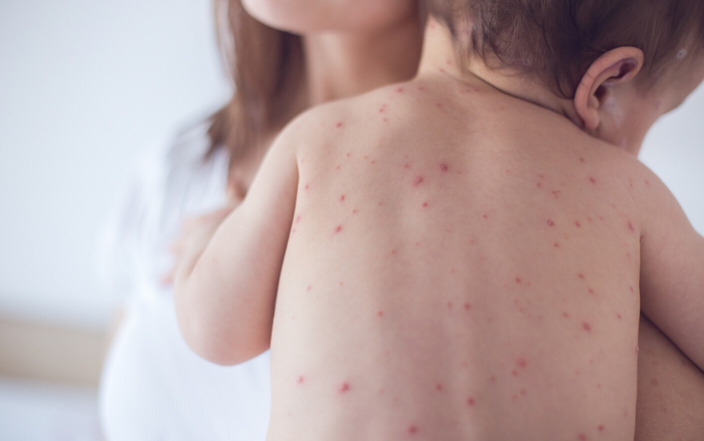 Epidemie de rujeolă: Cazurile cresc cu 3000% față de anul trecut. Ce trebuie făcut?