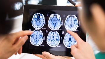 STUDIU. Implanturile cerebrale au ajutat 5 persoane să se recupereze după leziuni traumatice. Ce spun cercetătorii