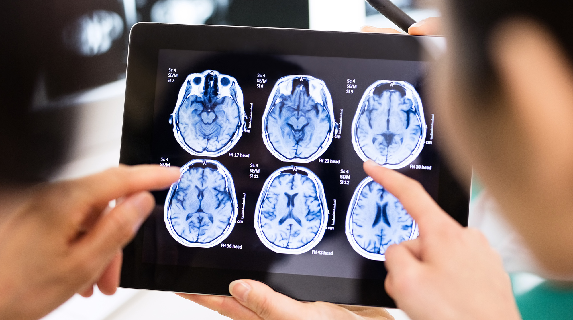 STUDIU. Implanturile cerebrale au ajutat 5 persoane să se recupereze după leziuni traumatice. Ce spun cercetătorii