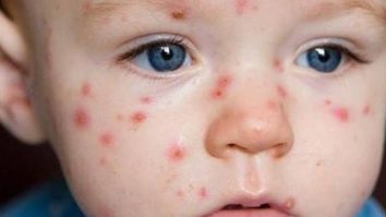 Oficialii din domeniul sănătății din Philadelphia urmăresc un focar de rujeolă