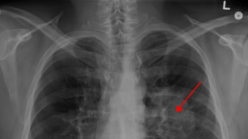 OMS anunță o creștere de 77% a cazurilor de cancer în următorii 26 de ani