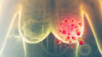 Sutienul îți poate monitoriza cancerul la sân