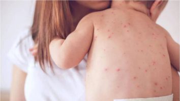 Marinescu: „Rujeola rămâne o problemă”. Poate fi prevenită cu ajutorul unei igiene corecte