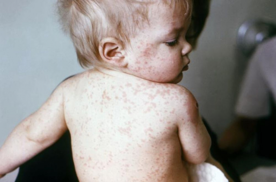 OMS: Cazurile de rujeolă s-au dublat într-un an. Adrian Marinescu: „Germania stă mult mai bine decât noi pentru că pun accent pe prevenție, adică prin vaccinare”