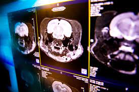 STUDIU. Creierul oamenilor moderni este cu 13% mai mic decât acum 100.000 de ani. Care sunt explicațiile