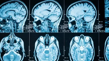 A.I. analizează imagini cerebrale pentru a detecta tulburările mintale. Cum poate influența acest model tratamentele psihologice