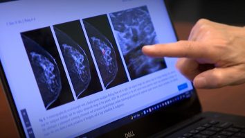 Specialiștii implicați în tratamentul cancerului de sân încep un studiu care utilizează software de Inteligență Artificială