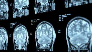 Fusobacterium: Bacteria care se găsește în gură face unele celule canceroase să se „topească”. Ce au descoperit cercetătorii