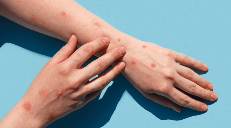 OMS declară variola maimuței o urgență globală. Adrian Marinescu: „Mpox nu are nicio legătură cu cea pe care o știm noi și care a fost eradicată”