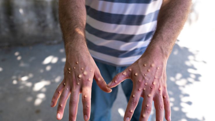 Un oficial OMS liniștește populația: „Mpox nu este noul COVID”
