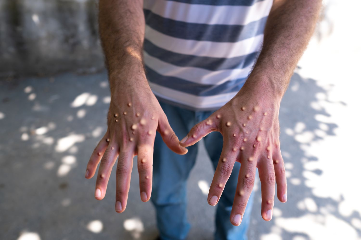 Un oficial OMS liniștește populația: „Mpox nu este noul COVID”