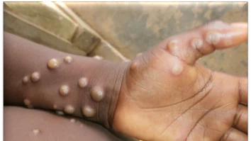 Pakistan a confirmat un caz de virus mpox la un pacient care s-a întors dintr-o țară din Golf