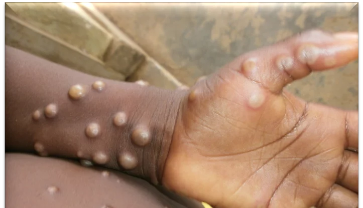 Pakistan a confirmat un caz de virus mpox la un pacient care s-a întors dintr-o țară din Golf