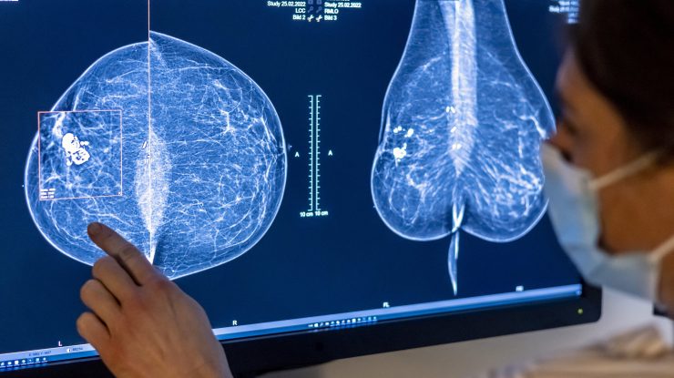 STUDIU. Inteligența Artificială îmbunătățește predicția cancerului mamar