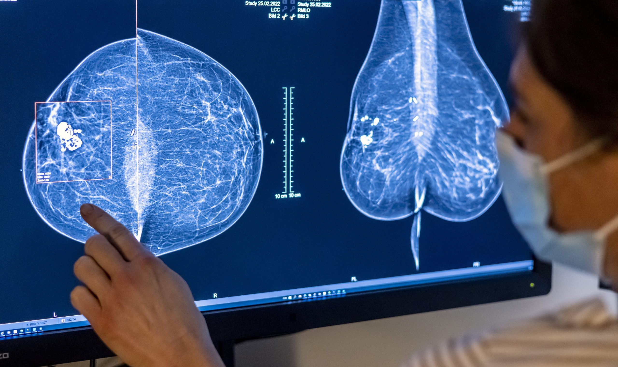 STUDIU. Inteligența Artificială îmbunătățește predicția cancerului mamar