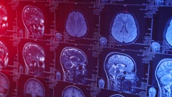 Cum revoluționează A.I.-ul medicina? Cercetătorii au dezvoltat un instrument pentru a analiza tumorile cerebrale în trei secunde