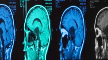 Cercetătorii propun un nou tratament pentru metastazele cerebrale rezistente la imunoterapie. Cum funcționează TIMP1