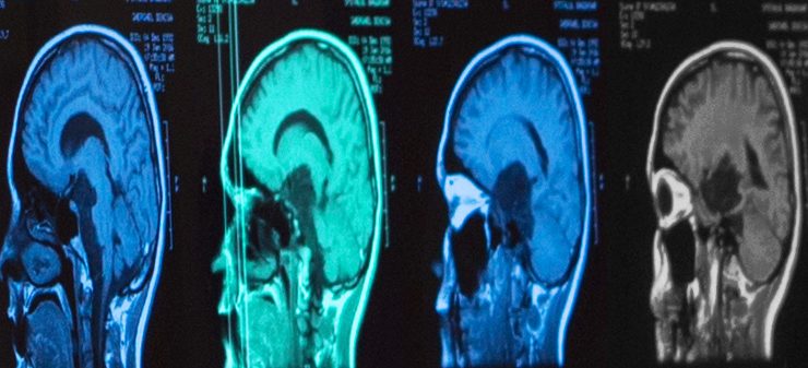 Cercetătorii propun un nou tratament pentru metastazele cerebrale rezistente la imunoterapie. Cum funcționează TIMP1