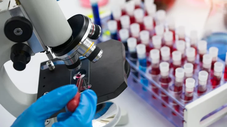 Cercetătorii britanici au creat un cip care detectează celulele canceroase. Anul trecut, peste 38.000 de români au murit din cauza cancerului