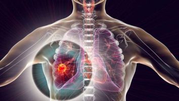 O echipă de cercetători au inventat un test de urină ce poate depista cancerul pulmonar