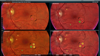 Inteligența Artificială schimbă regulile jocului în sănătatea ochilor. Cum pot detecta medicii mai rapid problemele