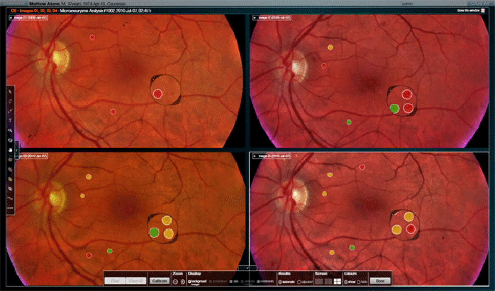 Inteligența Artificială schimbă regulile jocului în sănătatea ochilor. Cum pot detecta medicii mai rapid problemele