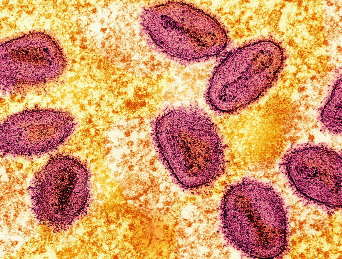 Un nou caz de Mpox a fost confirmat în Anglia: „Riscul rămâne scăzut”
