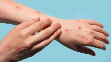 Franţa a confirmat primul său caz de virus mpox în Bretania