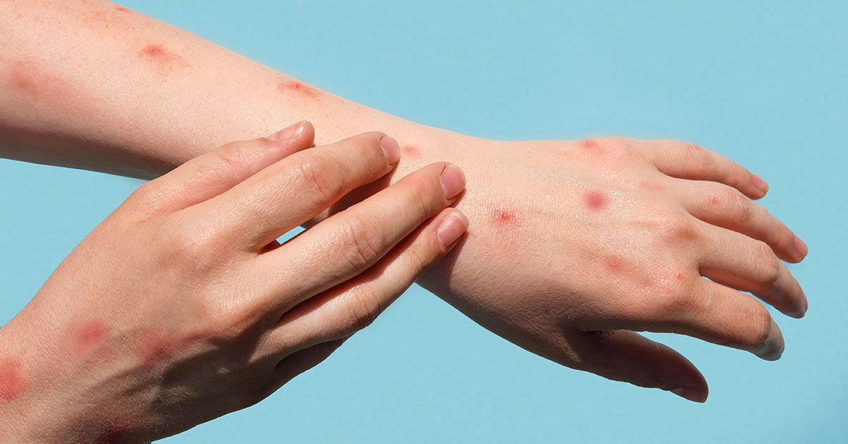 Franţa a confirmat primul său caz de virus mpox în Bretania