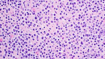 STUDIU. Mielomul multimul, un cancer al sângelui adesea considerat incurabil, ar putea avea leac