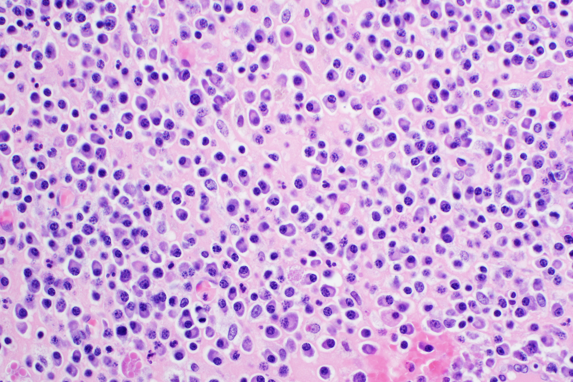 STUDIU. Mielomul multimul, un cancer al sângelui adesea considerat incurabil, ar putea avea leac